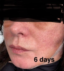 Having facelift surgery in 10 days - support and advice needed