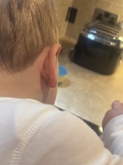 Scabby/ weeping behind ear