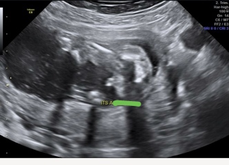 Gender scan