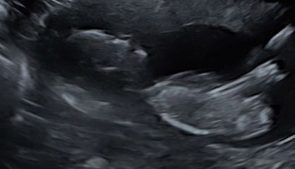 Please help! Girl Or Boy, Nub theory!