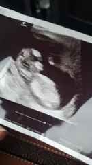 BOY OR GIRL? 12 week scan pic.