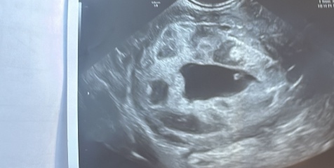 Empty sac with large sacs around currently 9 weeks