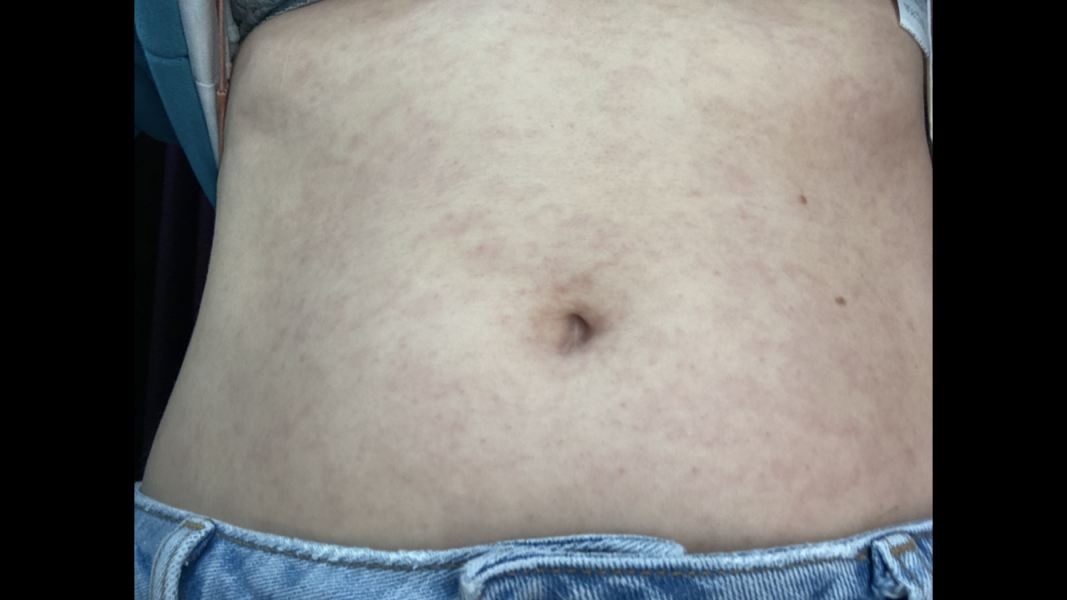 Strange rash on tummy for 4 days now