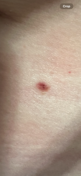 Could this be a melanoma?