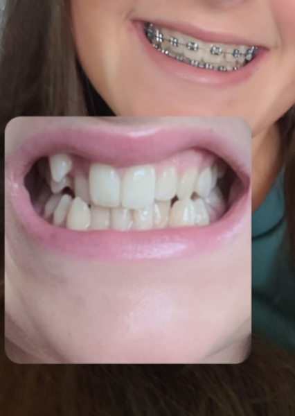 Getting my head around orthodontics for teens...