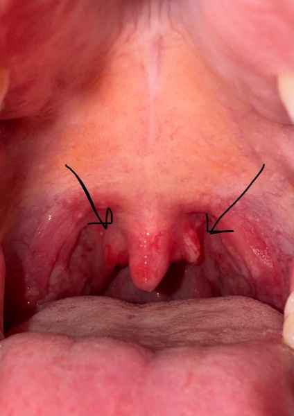 Strep - help!