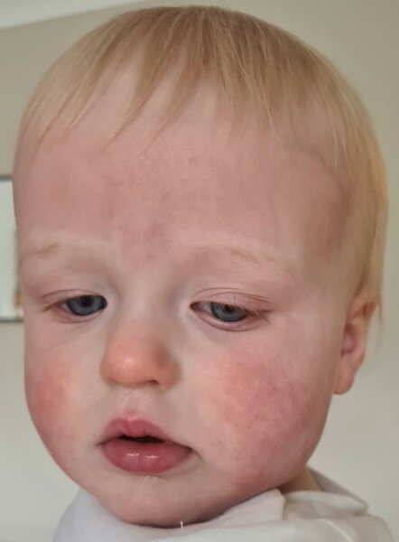 Red forehead? Teething? Slapped cheek?