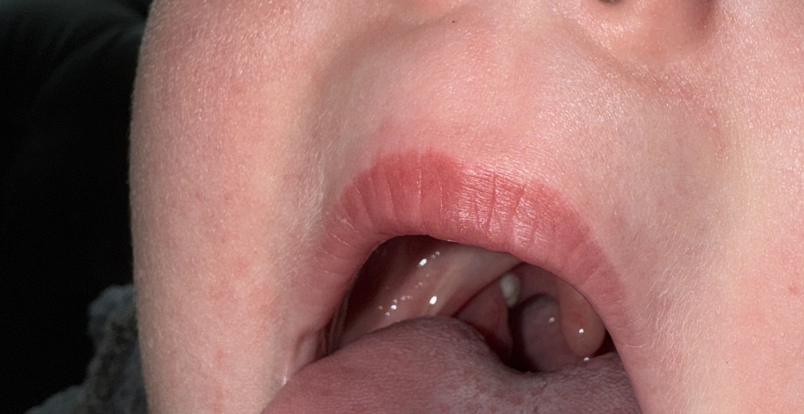 Does this look like tonsillitis?