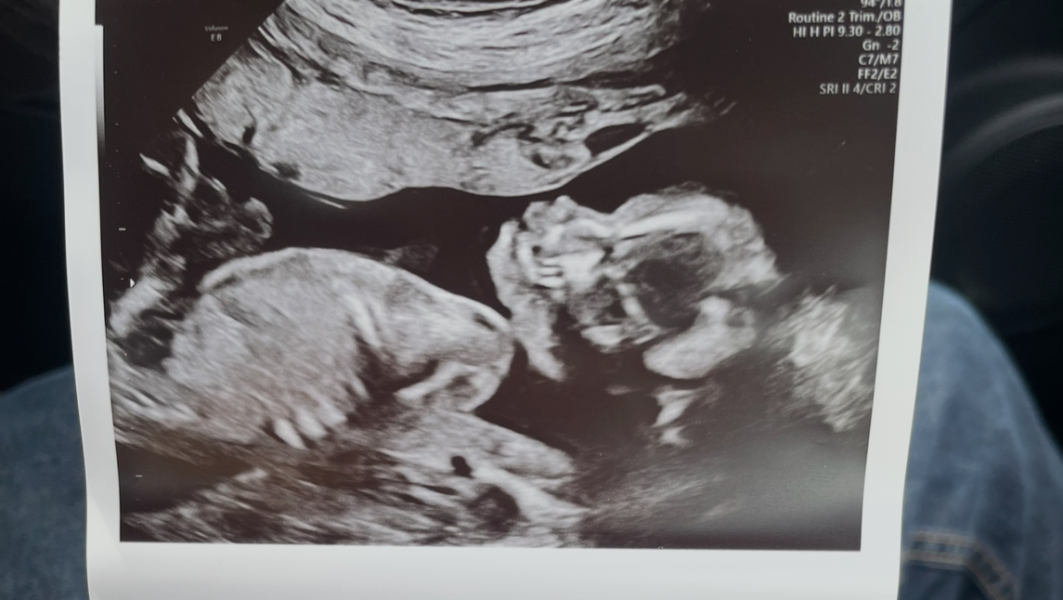 20 weeks gender prediction!
