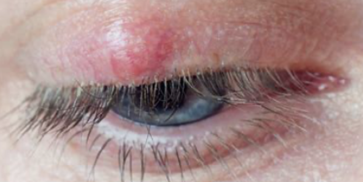 Chalazion