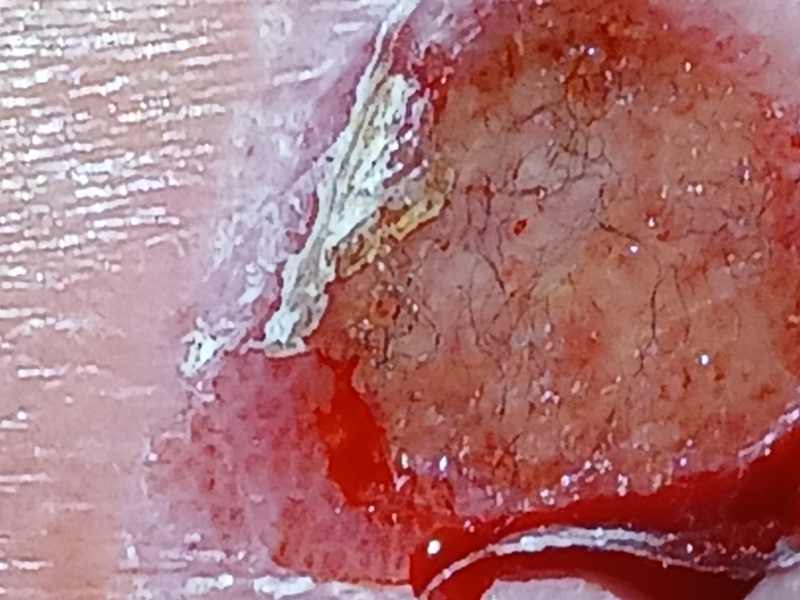 Episiotomy help!  **Content warning**