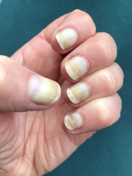 Badly damaged nails (photos)- please help!