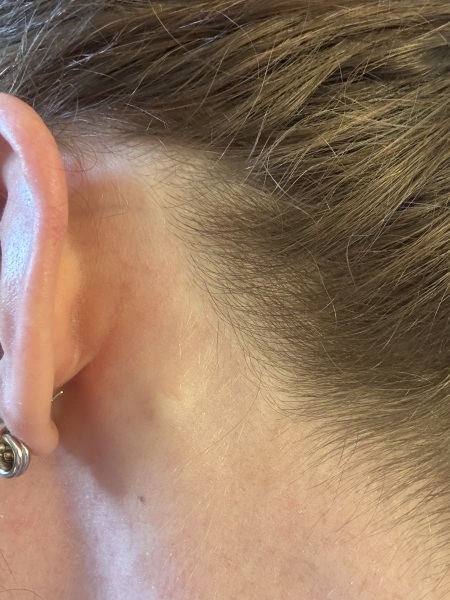 Hard lump behind ear base of skull