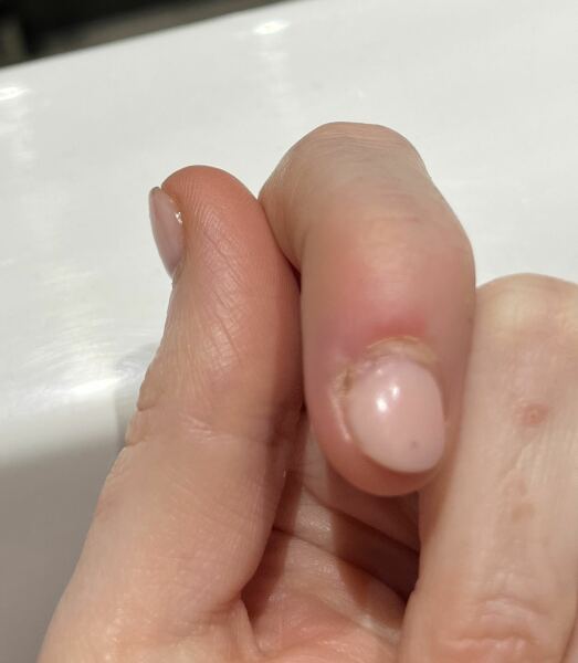 I think my nail is infected.