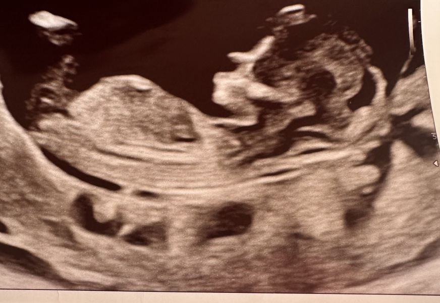 Nub theory, boy or girl?