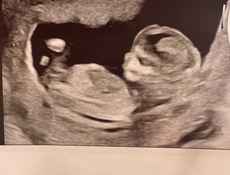 Nub, boy or girl?💗💙 12weeks & 3days x
