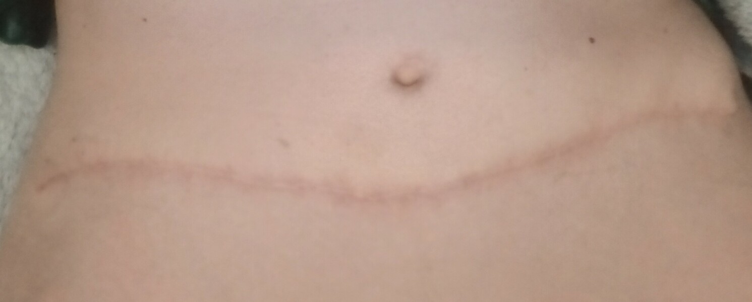 Breast reconstruction