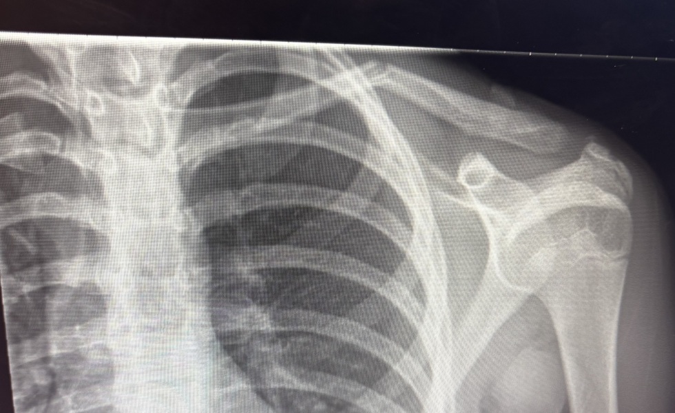 Angulated broken collarbone - advice needed