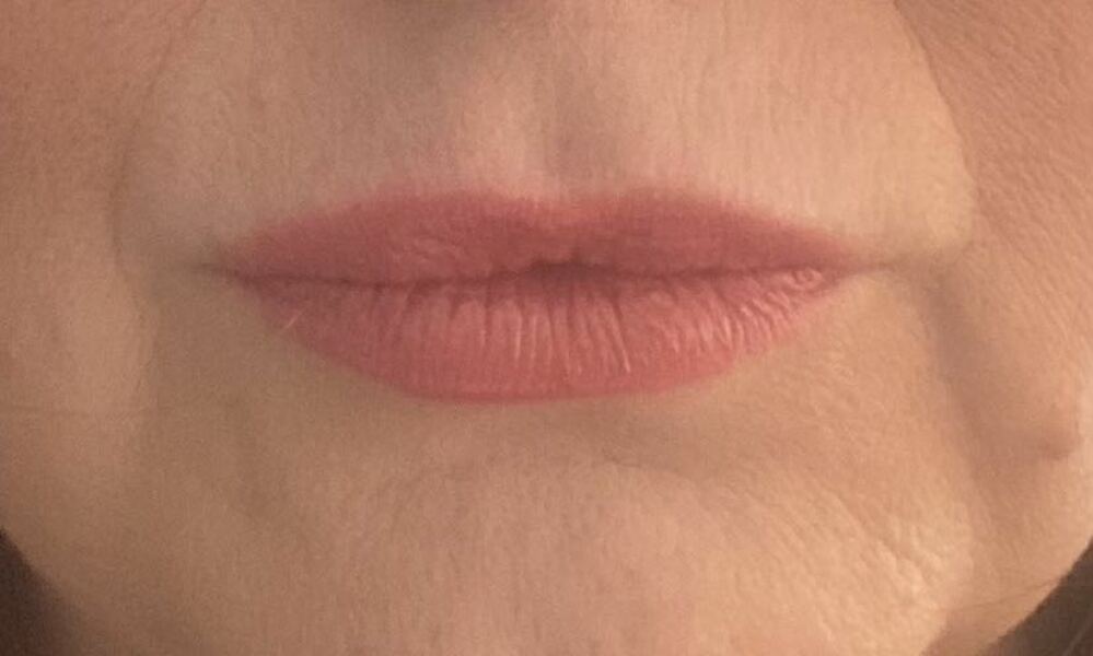 Lip fillers- are the agony?