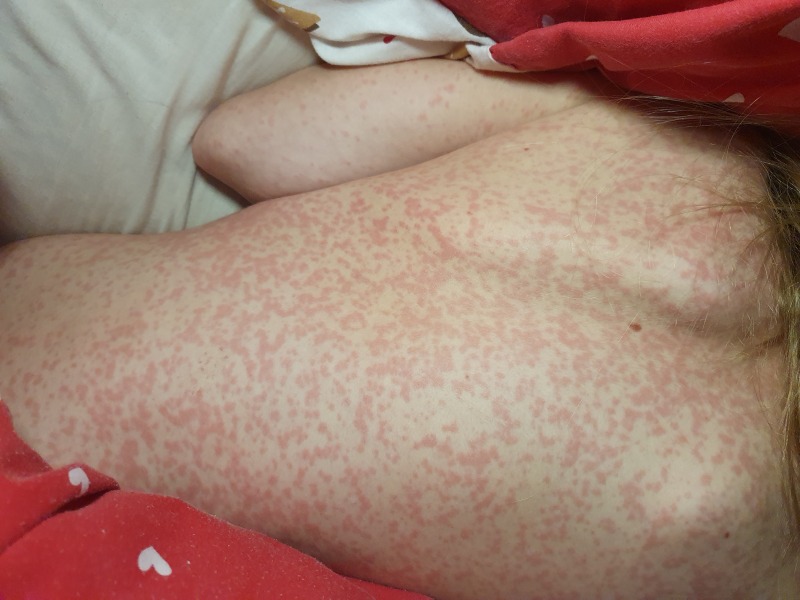 Strange rash on daughter need advice