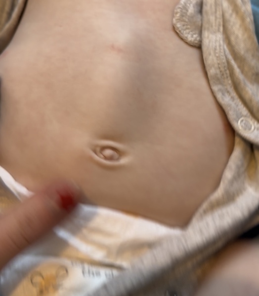 8 month old hernia advise