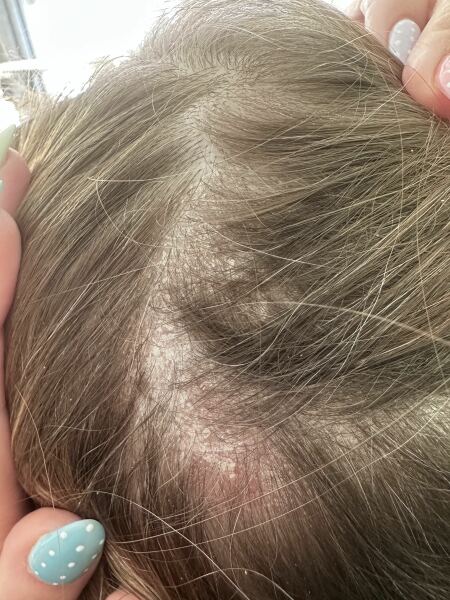 Scalp issues