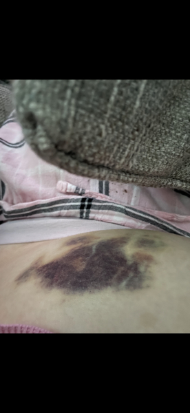 Bruising