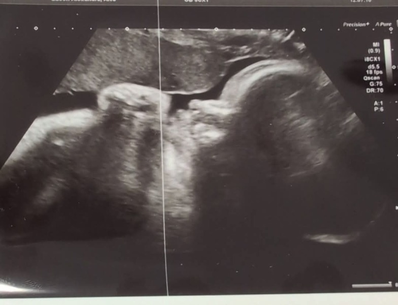 Any guesses on gender from scan?