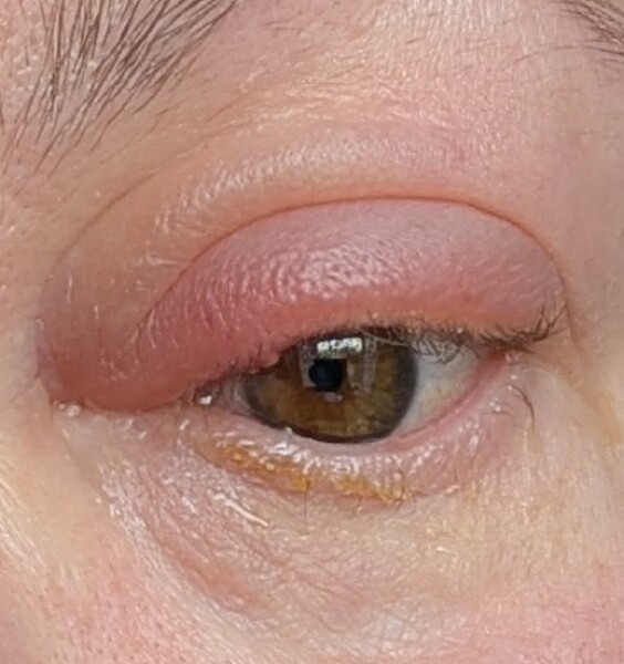 Best home treatment for blepharitis
