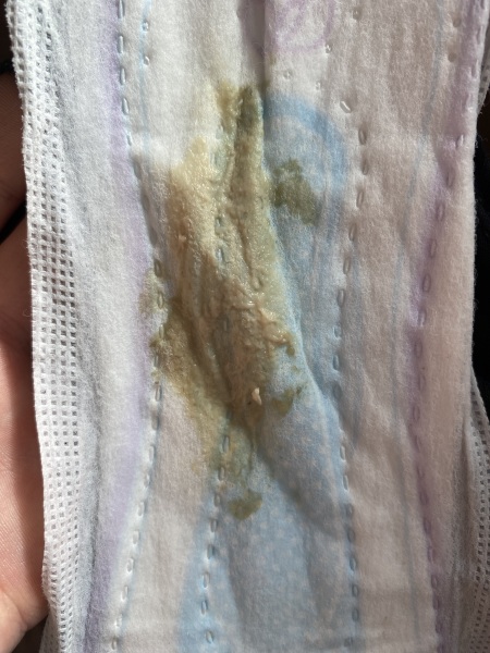 Is this mucus plug?