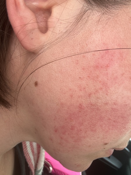 Rosacea help