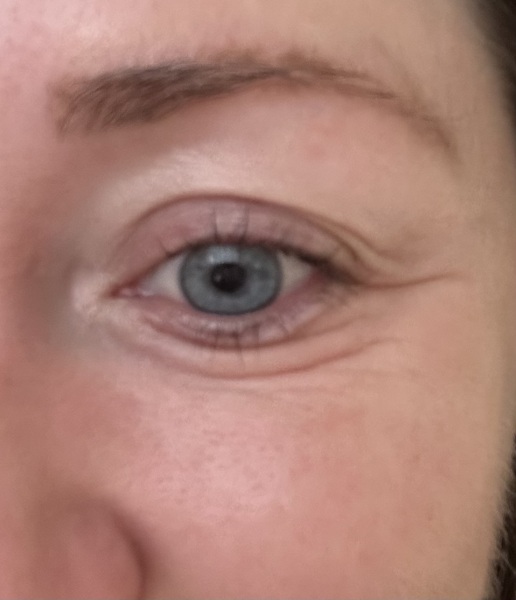 Is Botox the best thing for around the eyes?