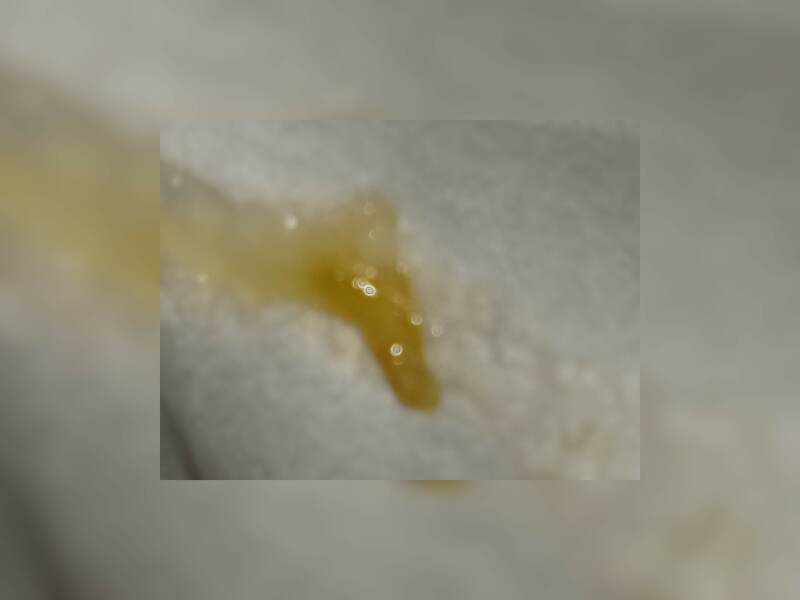 Can you blow a nasal polyp out? 