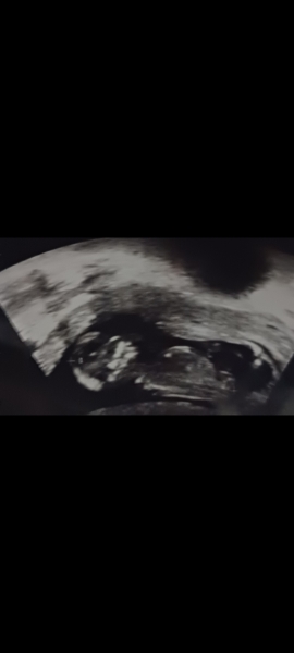 pregnancy13weeks skull/nub theory