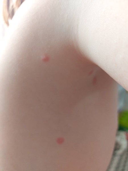 Bug bites or chickenpox?