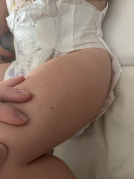 Should I get 4 year old’s mole checked?