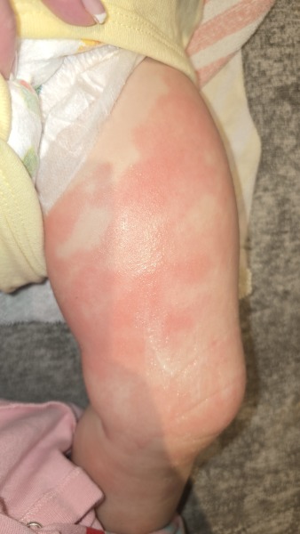 Does anyone know what this rash could possibly be?