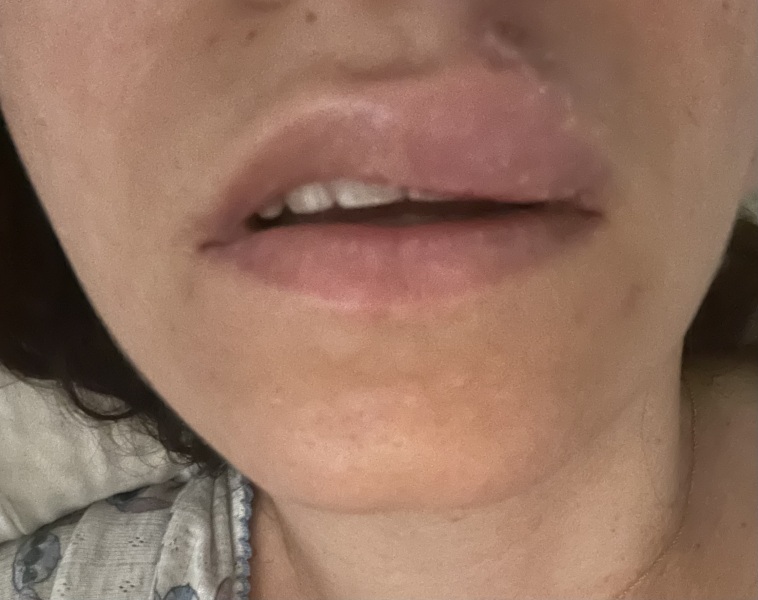 Cold sore so bad my lip is swollen in one side and I go back to work tomorrow!