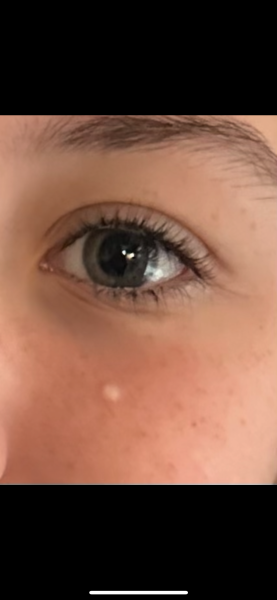 Deep blackhead on DS's forehead. Ideas for removal