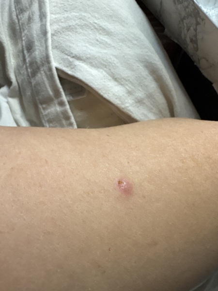 Advice needed Basal cell