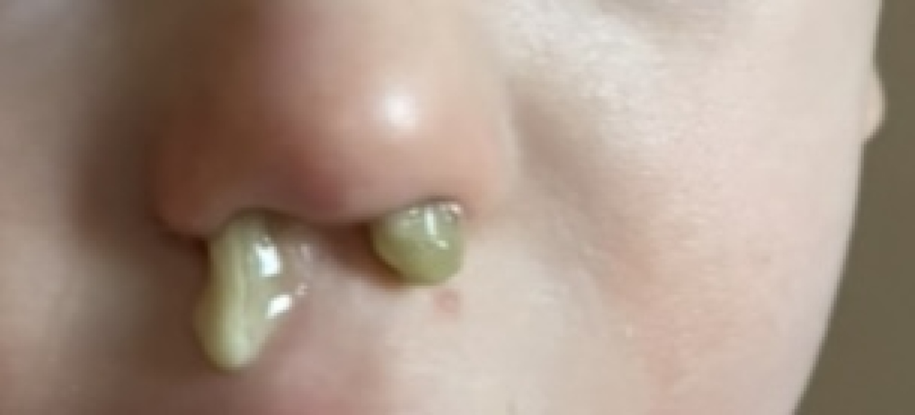 TW snot! Does this look infected?