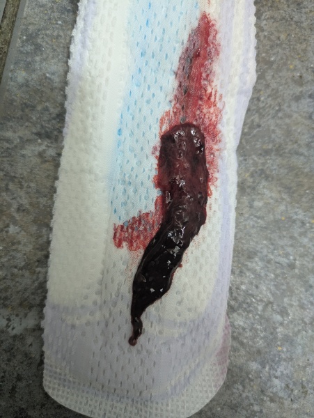 Do I need to be concerned - period clot (warning picture attached)