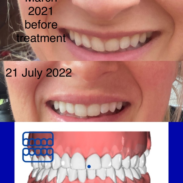 Anyone straightened teeth using cheaper alternatives to Invisalign?