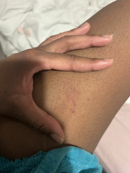 What could this be on my skin worried !