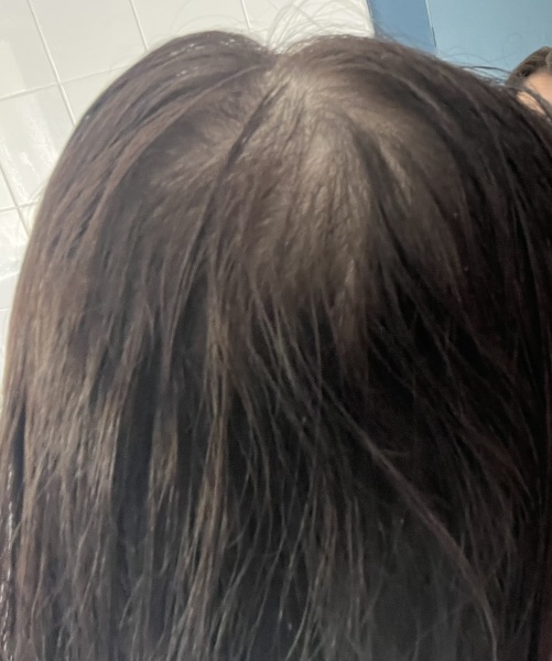 Balding? Thinning? Cowlick?