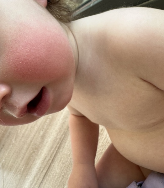 Rash advice on toddler (15 months)