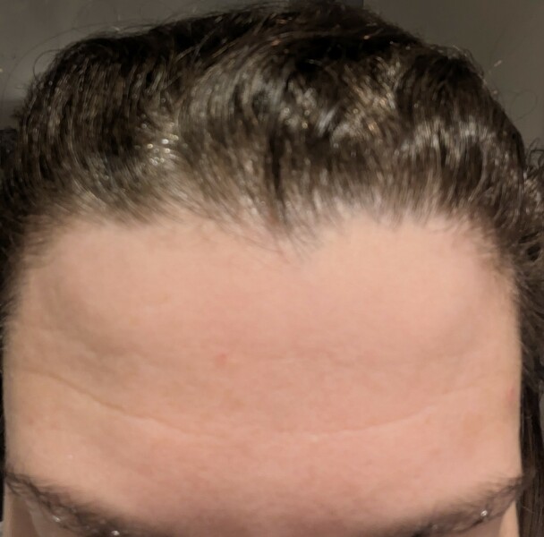 Botox alternatives