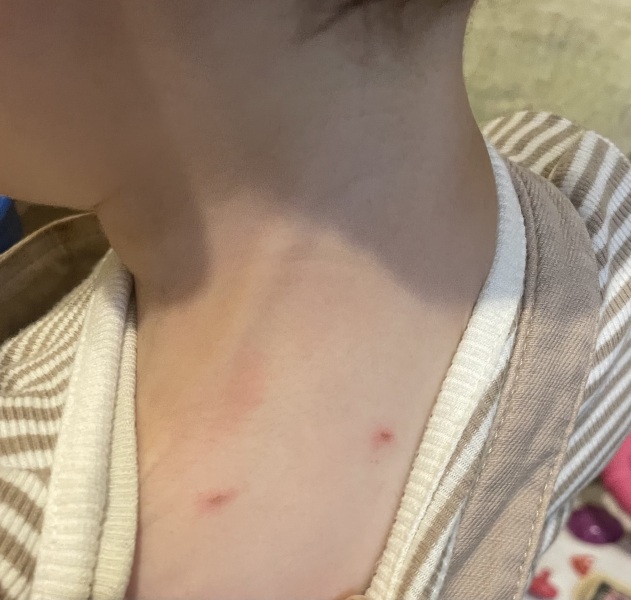 Help! Does this look like scabies?