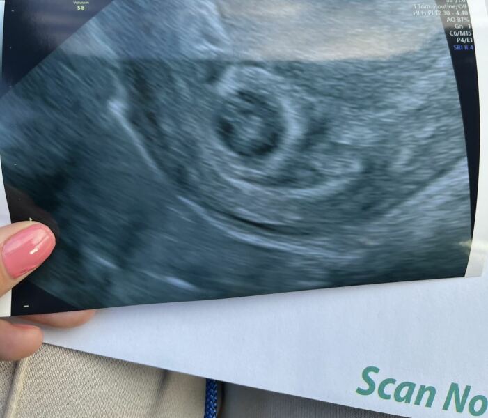 Bleeding 7 weeks pregnant