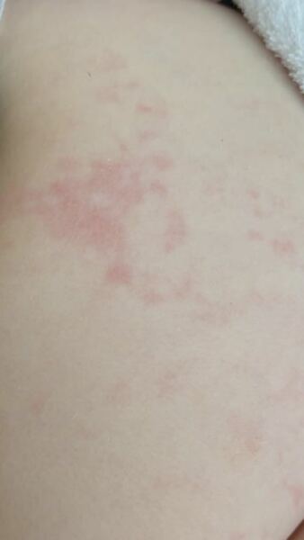 20 month old rash